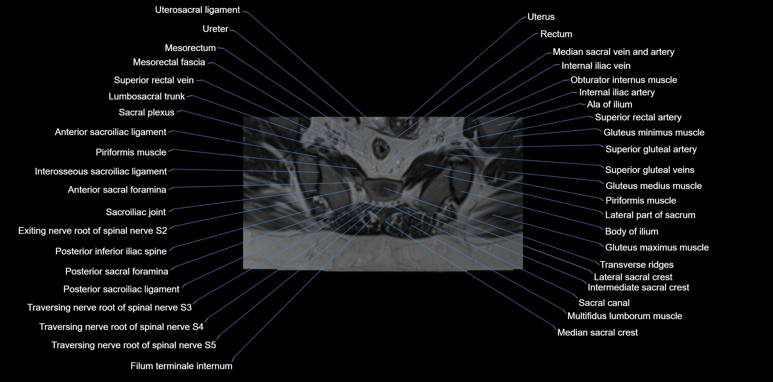 MRI sacrum, coccyx and sacroiliac joint axial cross sectional anatomy 3T  radiology  image-img-00001-00033.webp